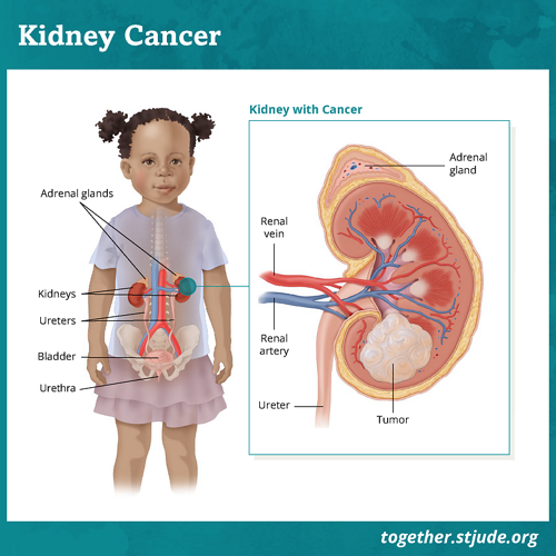 Grafika przedstawiająca przekrój przez ciało małego dziecka z uwidocznieniem narządów oraz wyróżnieniem i oznaczeniem nerek