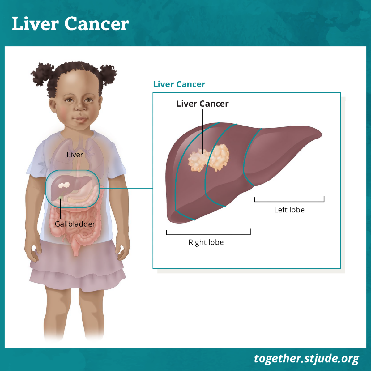 hepatic cancer leukemia
