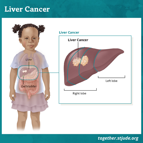 Liver Cancer in Children and Teens - Together