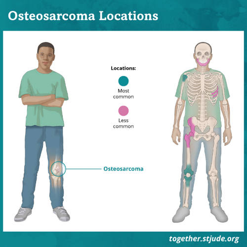 Symptoms of osteosarcoma depend on where the tumor is located. The most common places for osteosarcoma to develop are near the knee in the lower part of the thigh bone or the upper part of the shin. Another common place for osteosarcoma to develop is in the bone of the upper arm near the shoulder. Osteosarcoma may also develop in the pelvis or skull.