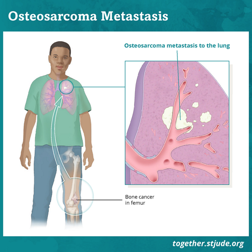 osteosarcome