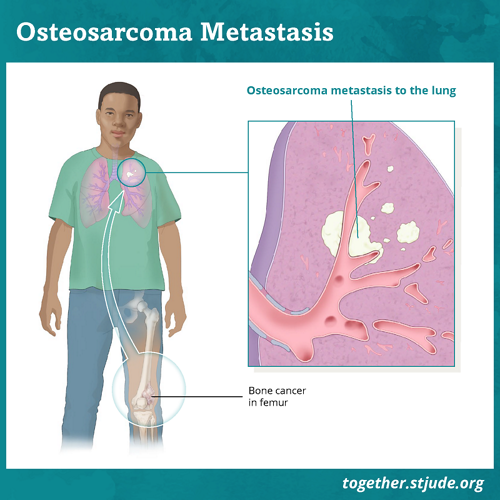 При метастатичній остеосаркомі пухлина поширюється на інші ділянки, наприклад, легені чи інші кістки. Найчастіше остеосаркома поширюється на легені.
