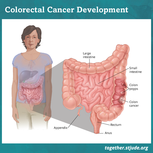 Colorectal cancer in childhood cancer survivors medical illustration