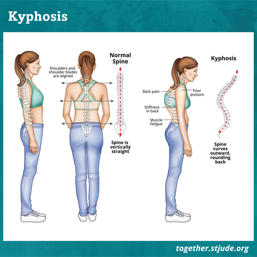 Ilustracja przedstawiająca porównanie zdrowego kręgosłupa i kręgosłupa z kifozą