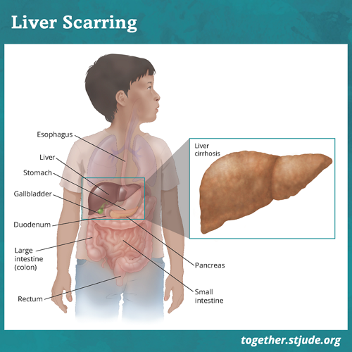 Liver scarring medical illustration