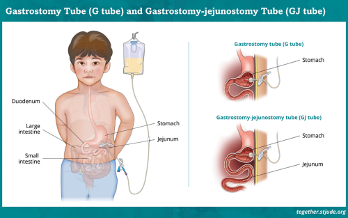 Gastrostomy Tube (G Tube) snf Gastrostomy-jejunostomy Tube (GJ tube)