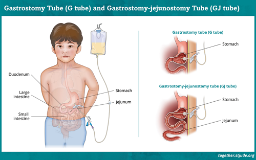 A medical illustration of the placement of a gastrostomy tube (G Tube) and a gastrostomy-jejunostomy tube (GJ Tube) 