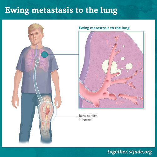 Метастатична саркома Юінга означає, що рак поширився на інші місця, такі як легені, кістки або кістковий мозок. Приблизно у 25 % пацієнтів є метастази на час діагностики. Приблизно у половини цих пацієнтів на момент встановлення діагнозу хвороба поширилася на легені.