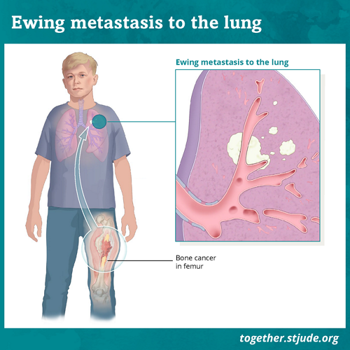 sarcoma cancer spread to lungs