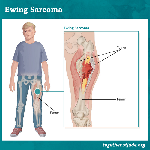 What is Ewing sarcoma? Ewing sarcoma is a type of cancer that grows in bones or in the soft tissue around bones. It often occurs in the leg, pelvis, ribs, or arm.