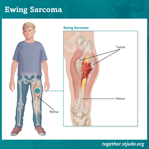 Ewing Sarcoma - Together by St. Jude™