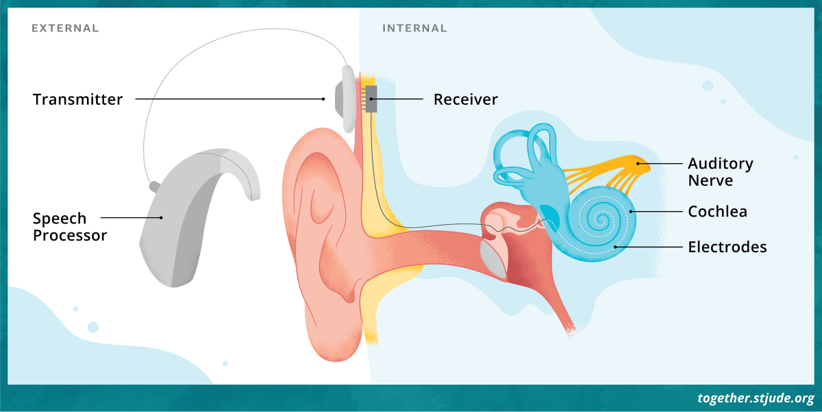 Cochlear Implants for Hearing Loss Together