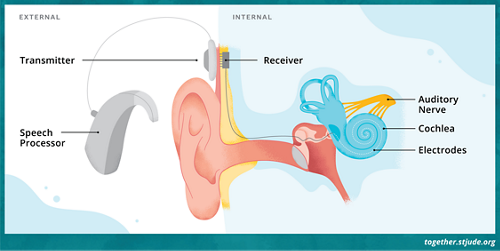 Un implant cochléaire se compose de deux parties principales qui fonctionnent ensemble : un dispositif externe porté derrière l'oreille et un dispositif interne placé pendant l'opération. Un aimant maintient les deux parties ensemble.