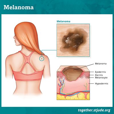 superficial spreading melanoma stages