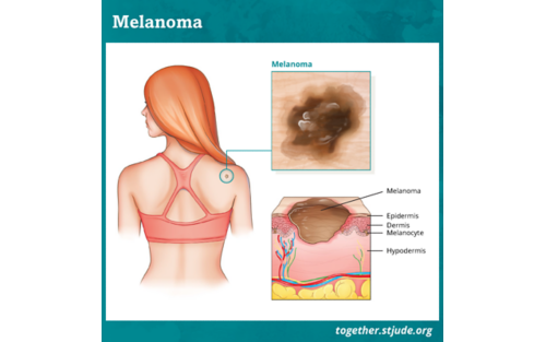Melanoma medical illustration