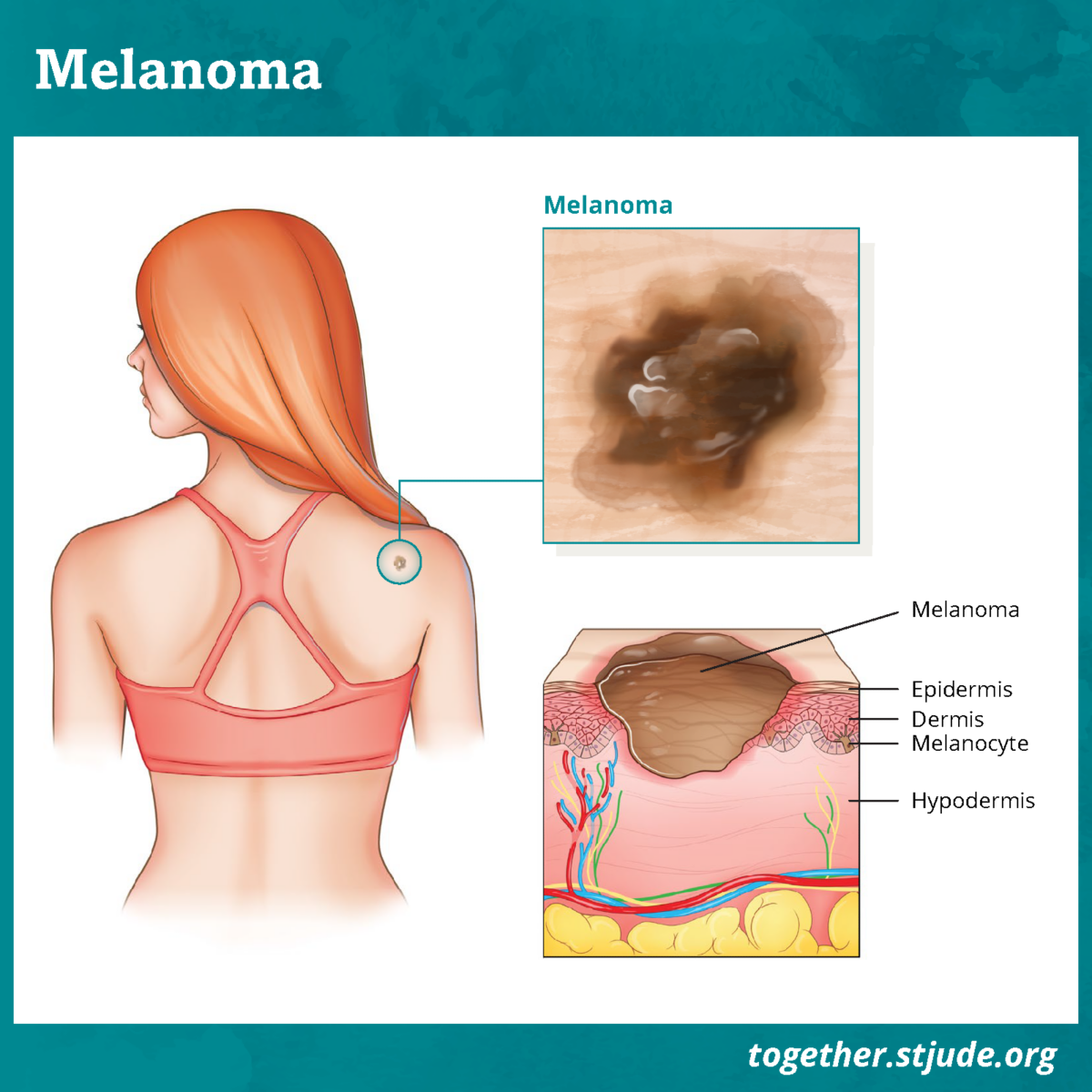 How to Spot Skin Cancer: Generations Family Practice: Family Medicine