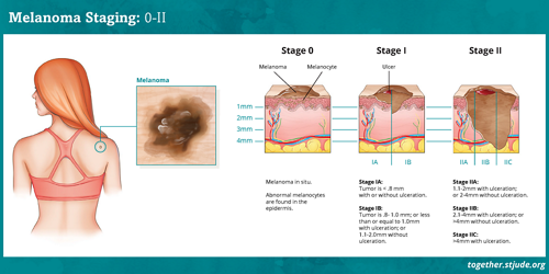 मेलेनोमा स्तर III और स्तर IV
