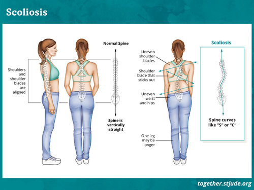 What is scoliosis? Scoliosis occurs when the spine rotates to the side.  A healthy spine appears as a straight line when viewed from the back. With scoliosis, the spine curves like the letter "S" or "C."