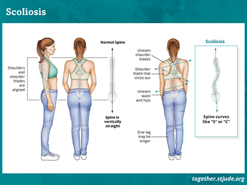 What Causes Scoliosis? Symptoms, Treatment, and Care at Neuro Spinal  Hospital