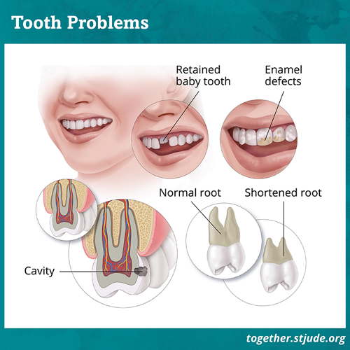 Several graphics showing tooth problems. The graphic on top left is of a retained baby tooth. The graphic on top right is showing enamel defects on a tooth. The graphic on bottom left is of a cavity. Graphic on bottom right is showing a shortened root. 