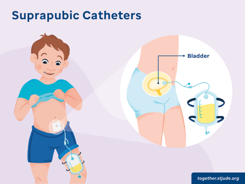 illustration showing boy with suprapubic catheter and how it is attached to bladder