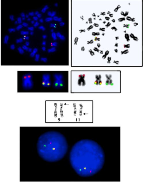 样本 FISH 图像包括 MLL 基因重新安排的示例。FISH 探针位于基因位置；如果为黄色，则显示正常。如果基因被分裂，则黄色分离成绿色和红色信号。该示例显示了有时在急性髓细胞白血病患者中观察到的分离。