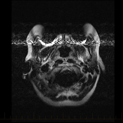 MRI with metal artifact from braces cause bright and dark lines across the image (arrows) and a black shadow (curved arrows) that covers up the area of interest.
