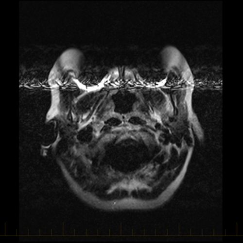 بریسز کے مصنوعی دھات کے ساتھ MRI