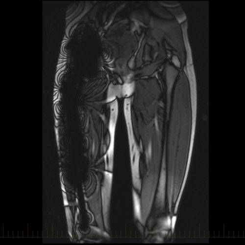 МРТ стегнової кістки дає металевий артефакт, який виглядає як чорна тінь над правою стегновою кісткою (стрілки). Порівняйте його зі звичайною лівою стегновою кісткою (вигнуті стрілки), яка не має металевого артефакту.
