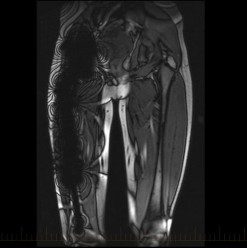 သတ္တုအကြွင်းအကျန်ကို ပြသော ပေါင်ရိုးတစ်ချောင်း၏ MRI