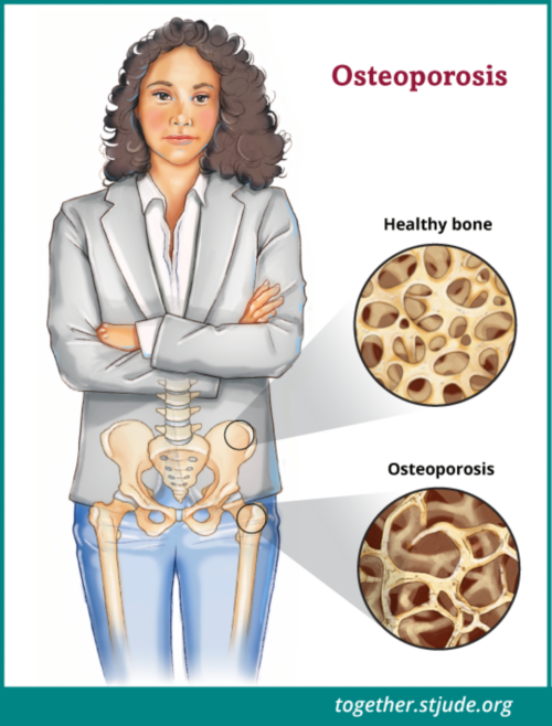 Osteoporosis Causes