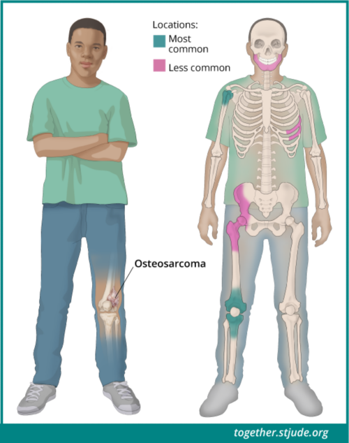 Os sintomas de osteossarcoma dependem de onde o tumor está localizado. Os locais mais comuns para o desenvolvimento de osteossarcoma são próximo ao joelho, na parte inferior do osso da coxa ou na parte superior da canela. Outro lugar comum para o desenvolvimento de osteossarcoma é o osso do braço superior próximo ao ombro. O osteossarcoma também pode se desenvolver na pelve ou no crânio.