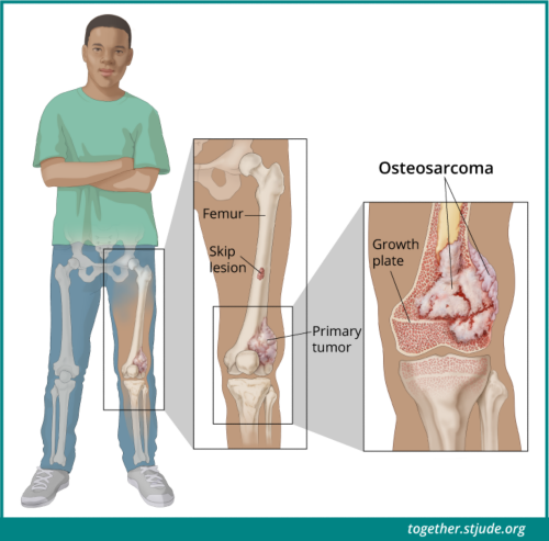 اوسٹیوسارکوم ہڈیوں میں ہونے والا ایک قسم کا کینسر ہے۔ اوسٹیوسارکوما کسی بھی ہڈی میں بڑھ سکتا ہے، لیکن یہ عام طور پر ٹانگ یا بازو کی لمبی ہڈیوں کے وسیع سرے میں تیار ہوتا ہے۔ اوسٹیوسارکوما ہڈی کے اندر (مرکزی ٹیومرز) یا ہڈی کے خارجی سطح (ٹیومر کے سطح) پر بن سکتا ہے۔ زیادہ تر پیڈیاٹرک اوسٹیوسارکوما ہڈی کے اندر بیچ میں ہوتا ہے۔ ایکسرے جیسے امیجنگ ٹیسٹ کا استعمال اسکپ زخموں کی جانچ کے لیے کیا جا سکتا ہے۔ اسکپ زخم تب ہوتا ہے جب کینسر بنیادی ٹیومر سے ہڈی کے دوسرے حصوں تک پہنچ جاتا ہے۔