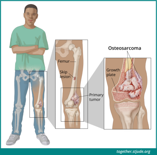 Osteossarcoma em crianças e adolescentes - Juntos