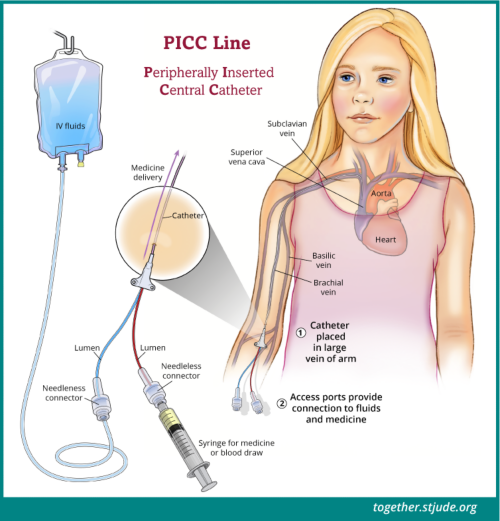 A PICC line is inserted into a vein on the inside of the upper arm and extends into a larger vein leading to the heart. One end of the catheter stays outside the skin and has one or two tubes called lumens.