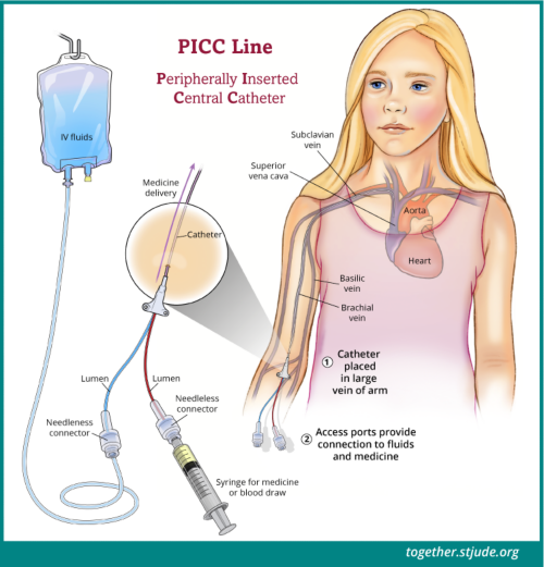 O cateter PICC é inserido em uma veia na parte interna da parte superior do braço e se estende para uma veia maior que leva ao coração. Uma extremidade do cateter permanece fora da pele e tem um ou dois tubos chamados lúmens.