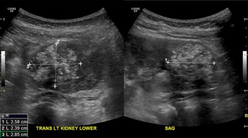 Exames de imagem, como o ultrassom, ajudam os médicos a saber o tamanho do tumor. O ultrassom também mostra se o tumor se espalhou.