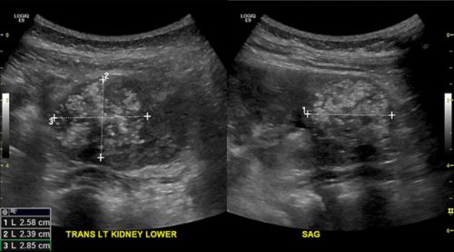 Las pruebas por imágenes, tales como el ultrasonido, ayudan a los médicos a determinar el tamaño del tumor. Los ultrasonidos también muestran si el tumor se ha diseminado.