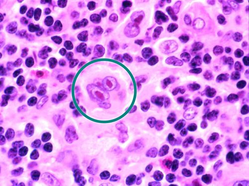 Reed-Sternberg cells, which have the appearance of owl eyes, shown in a teal circle.