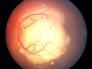Esta é uma imagemdo Grupo C de tumores de retinoblastoma. Os tumores do Grupo C têm um risco moderado de perda do olho. Os tumores do Grupo C são bem definidos, em sua maioria, com pequenas quantidades de propagação ou sementes.