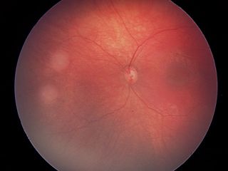 这是视网膜母细胞瘤肿瘤组 A 组的 EUA 照片。肿瘤组 A 的失眼风险非常低。组 A 包括仅位于视网膜的小肿瘤；不接近重要结构。