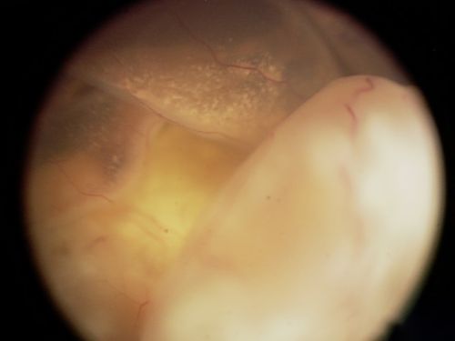 This is an EUA picture of retinoblastoma tumor group E. Tumor group E has very high risk of losing the eye. A Group E tumor is a very large tumor that affects eye structure and function. There is a higher chance of spread.