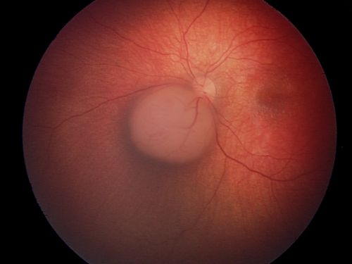 This is an EUA picture of retinoblastoma tumor group B. Tumor group B has low risk of losing the eye. Group B includes a larger tumor that is located near important structures.