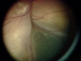 这是视网膜母细胞瘤肿瘤组 D 的 EUA 照片。肿瘤组 D 有较高的失眼风险。组 D 肿瘤较大或边界不清楚，伴大量种植。