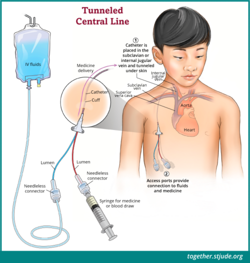 A tunneled central line is a central venous catheter that is tunneled under the skin and inserted into a vein under the collarbone or in the neck. Then it is guided through the vein until it reaches the correct place near the heart. A cuff around the catheter helps to hold the tubing in place and act as a barrier to infection.