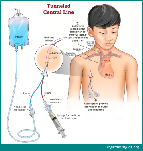 central line catheter jugular