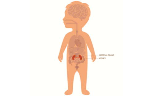 Medical illustration of neuroblastoma adrenal glands