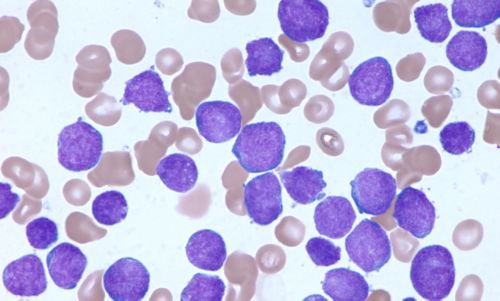 Histology slide shows the bone marrow of a pediatric acute lymphoblastic leukemia patient under a microscope. 