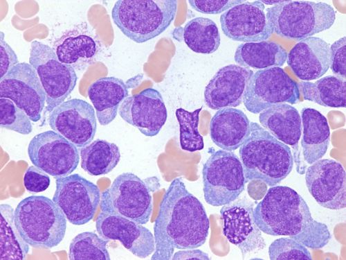 Microscope image shows bone marrow of a patient with acute myeloid leukemia
