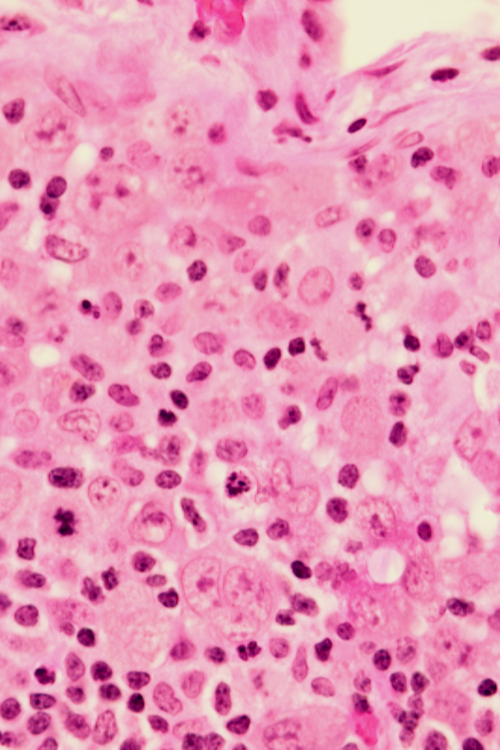 Image of anaplastic large cell lymphoma